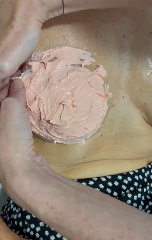 Prothèse d'aréole mammaire sur mesure en silicone médical après mastectomie