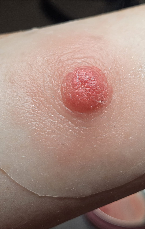 Prothèse d'aréole mammaire sur mesure en silicone médical après mastectomie